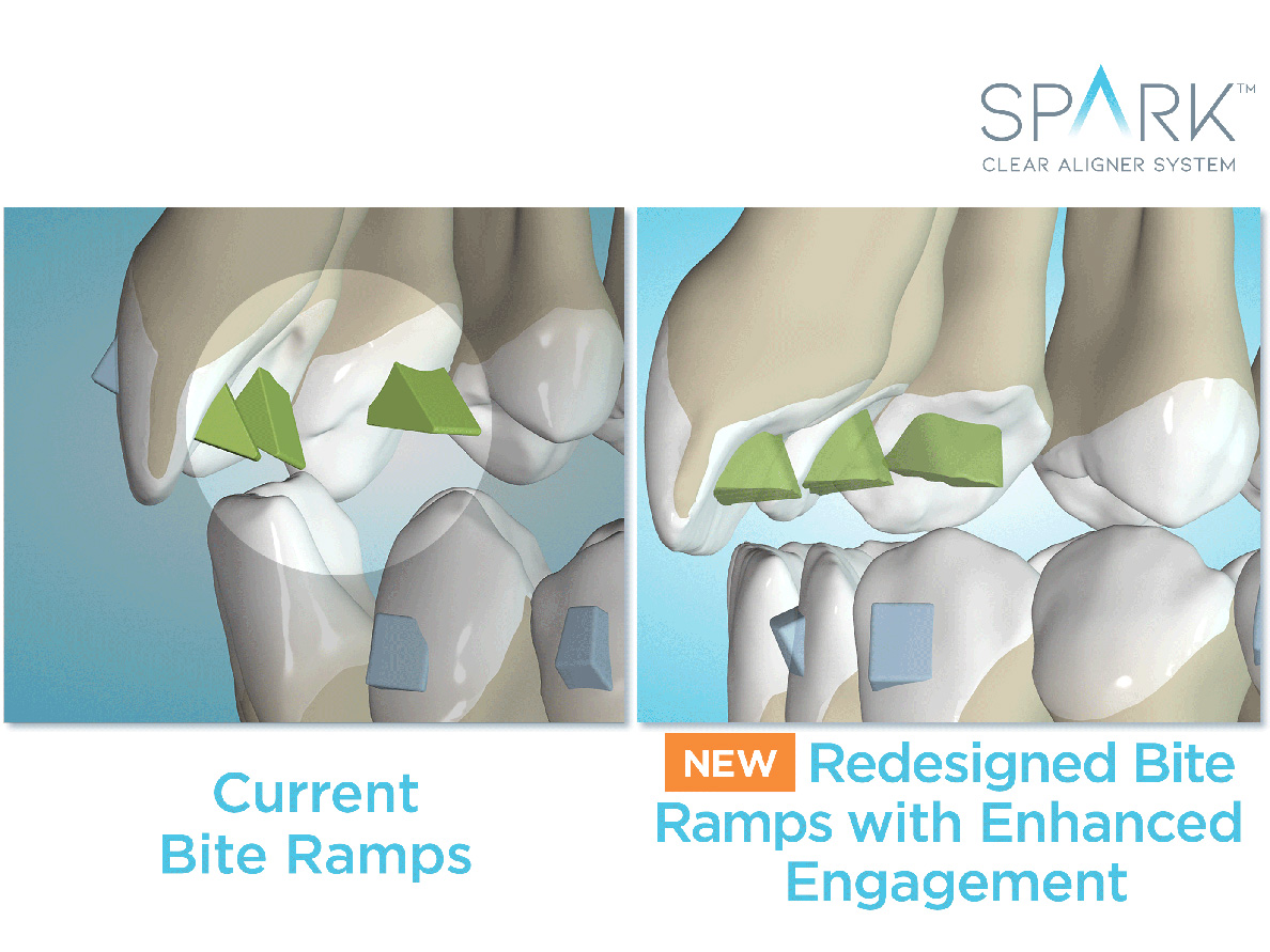 Ormco announces FDA approval to treat mixed dentition with Spark clear ...